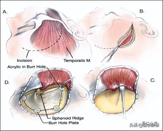 神经外科手术入路解剖翼点入路
