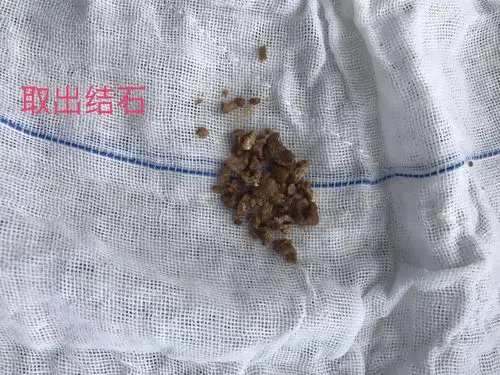 经皮肾镜下肾结石的微创治疗