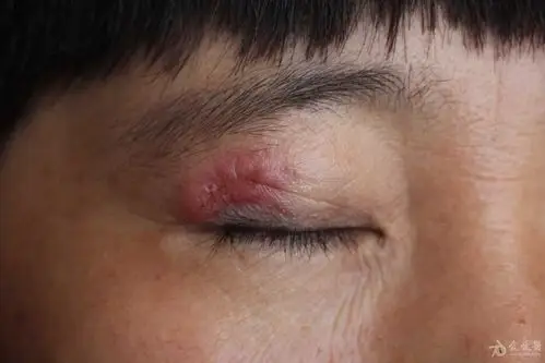 典型病例——眼睑孢子丝菌病.