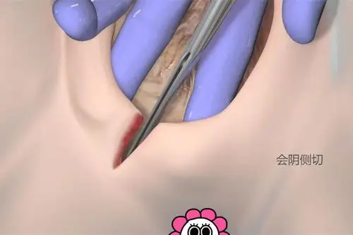 一组图告诉你顺产侧切原来真的是切一刀网友想想都疼