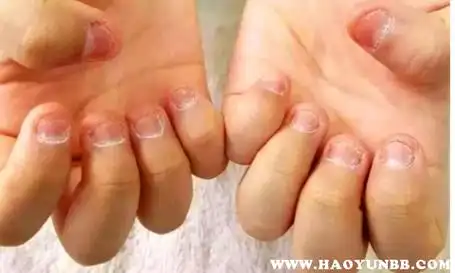 咬指甲会导致什么后果经常咬指甲的图片