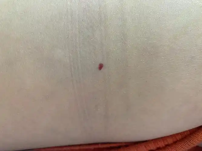 身上的"朱砂痣"or心里的"白月光"_皮肤血管瘤_介绍_治疗方式 - 好大夫