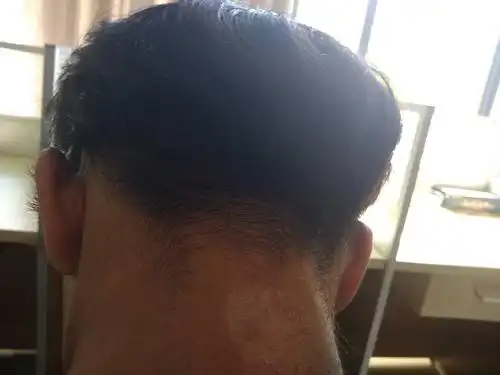 脖子后面这里长了一块藓,怎么办.