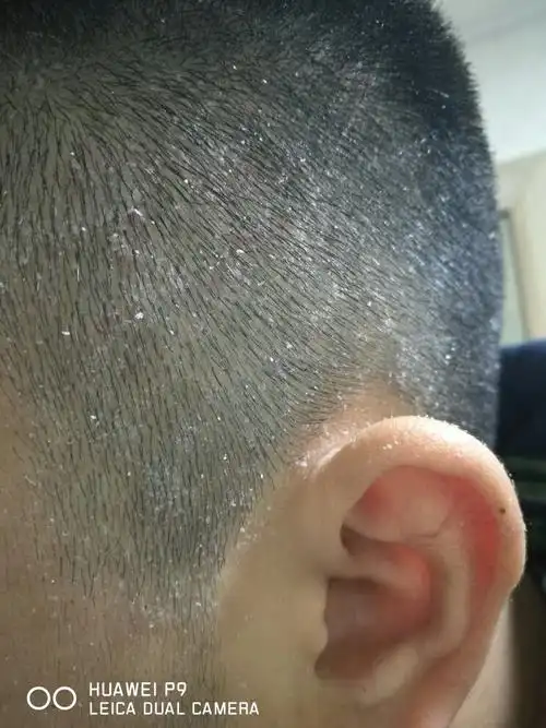这种头皮屑怎么治