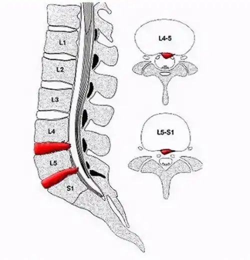 腰4~5(l4~l5),腰5~骶1(l5~s1)腰椎间盘突出症在腰椎各个节段均可发生