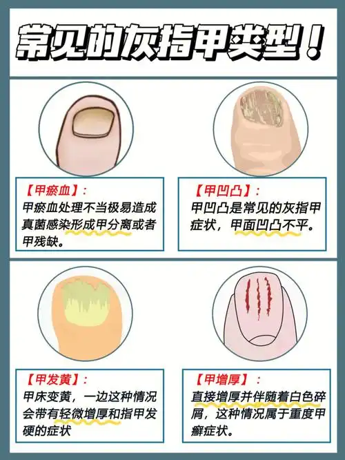 灰指甲的危害你居然还不知道速看