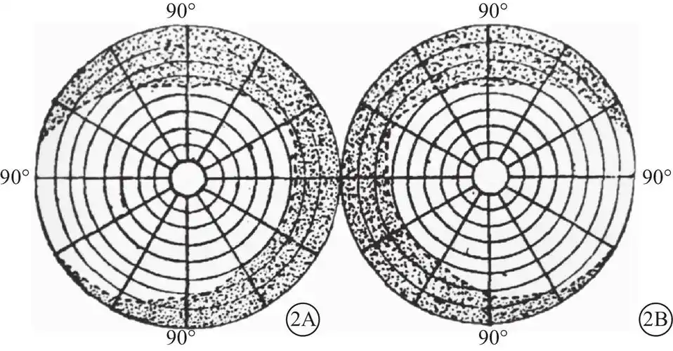 急性孤立性枕叶脑梗死患者治疗前后的视野缺损变化