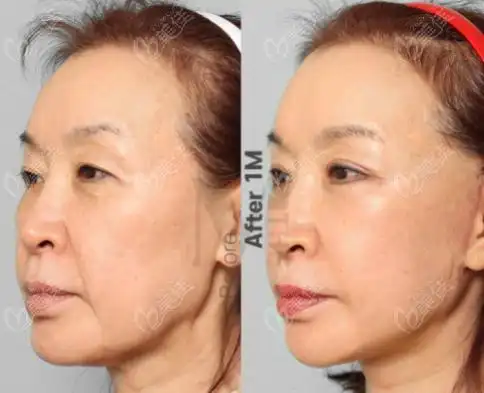 三组韩国迪美整形面部拉皮手术对比照片价格和维持时间略有不同