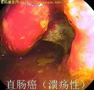 肠镜图片直肠癌