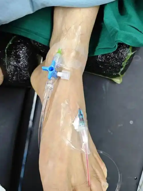 足背动脉穿刺置管在手术麻醉中,足背动脉穿刺置管用于血压监测,是一项