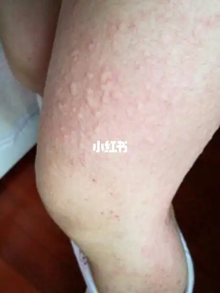 荨麻疹怎么办?分享我的小妙招