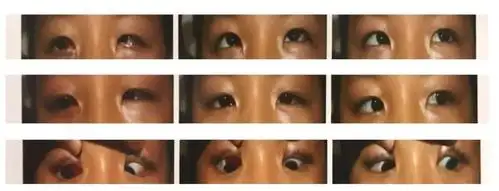 由郑丽梅主任接诊,经过详细检查后,诊断为"垂直性斜视,会聚性共同性