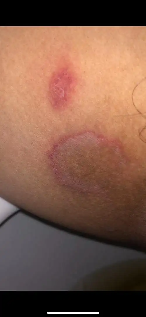 大腿内侧这样很痒.怎么回事?