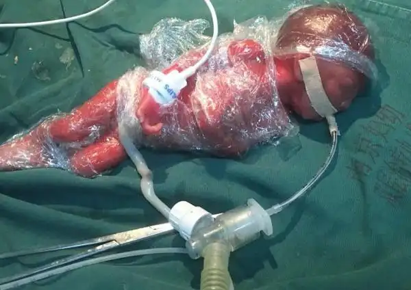 南京市妇幼保健院成功救治22 2周超早产儿,刷新国内最小胎龄超早产儿