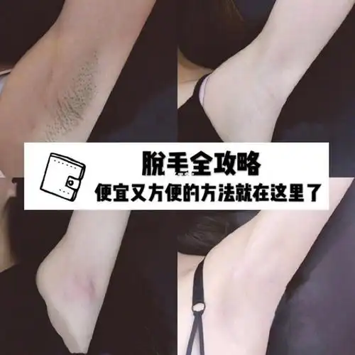 脱毛全攻略