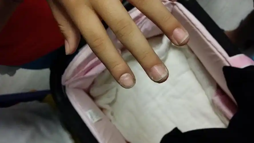 问:8岁孩子指甲这样了,是缺什么维生素吗