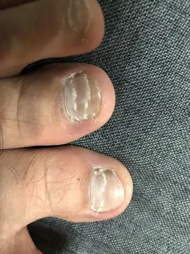 脚大拇指甲有断横?