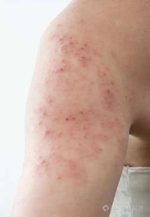 2644*3832px发票合同问题/病症疾病皮疹皮炎感染湿疹疼痛过敏查看作者