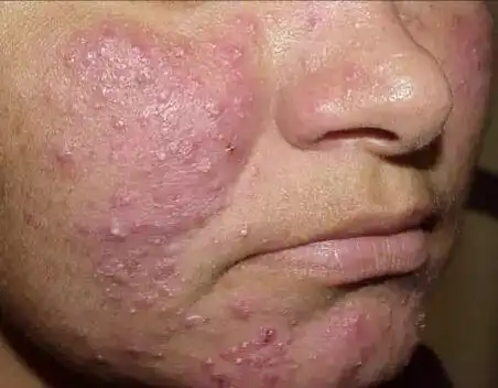 酒渣鼻涂上酒精为什么特痒?