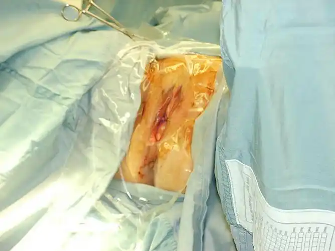 【一组图片】阴道切除子宫和膀胱脱垂的手术