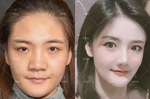 在鼻头低平圆钝的情况下,千万不要随意缩小鼻翼.