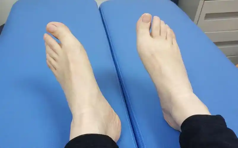 患者,走路的特征是歪臀跛行一一简单的表现可归纳为: 阴阳脚,与长短脚