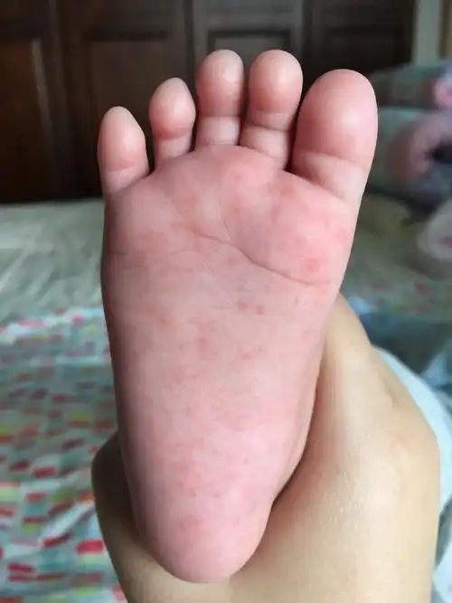 家有女宝4个半月今天突然发现脚底起了好多小红点手掌也零星