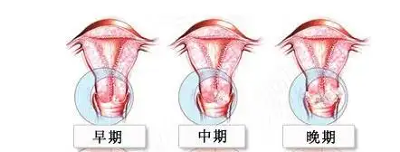 子宫癌晚期能治好吗
