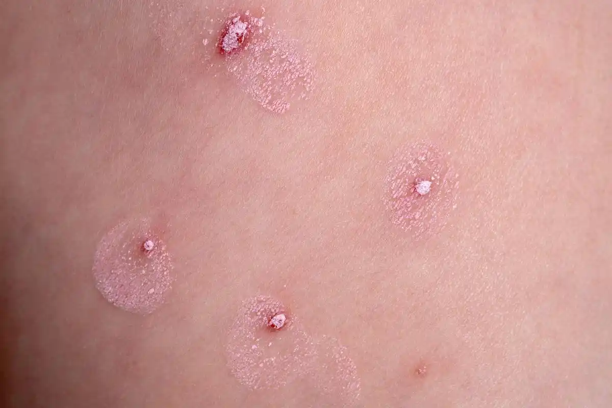 水疱疹一般指的是带状疱疹,是一种急性病毒感染性皮肤病,一般是感染