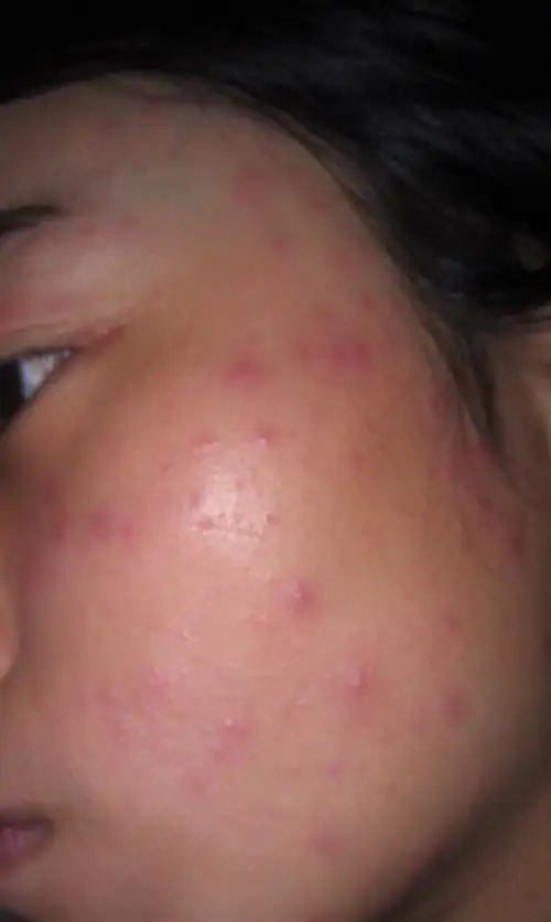 这是紫外线过敏么?