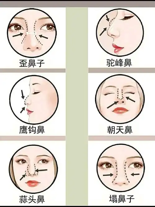 我们的鼻子从外观来看,可分为鼻根,鼻背,鼻尖,鼻中_圈子-新氧美容整形