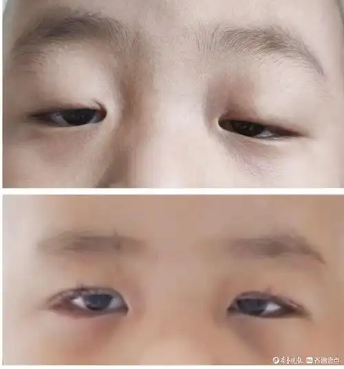 5岁娃罹患先天性上眼睑下垂聊城眼科专家妙手让他眼界大开