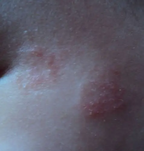 大家帮忙来看看宝宝脸上是癣吗?怎麼办?