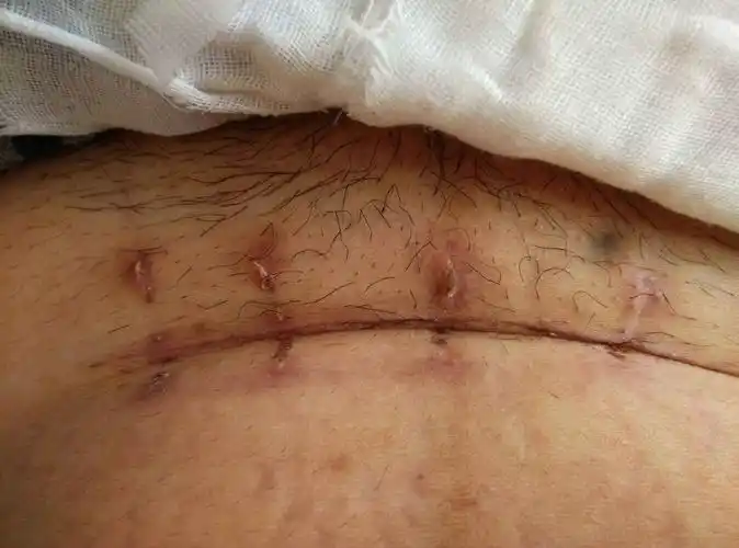 抛腹产刀口半个月的图片,剖腹产手术20天伤口图片-图片大观-奇异网