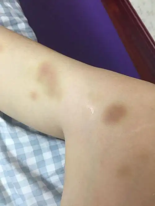 还有我腿部的淤青是做完运动刮腿