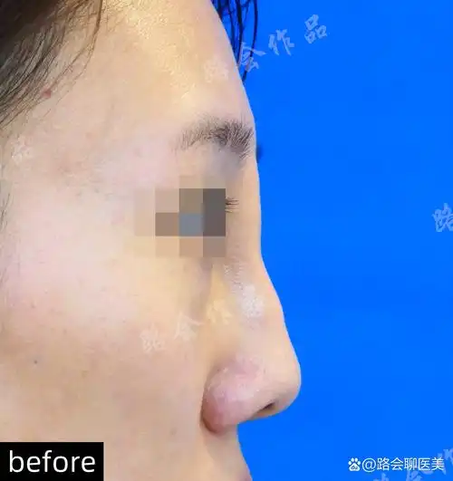 骨粉隆鼻"的求美者,因为骨粉发生了移位,皮下结节,后来形成了"通天鼻"