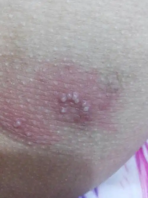 老公前几天发现屁股起几个小白包,白包聚集一起,周边有些红.