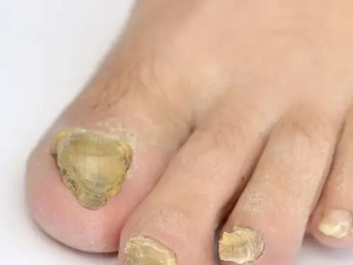 特别是身体内维生素d和钙元素的缺乏,会导致指甲逐渐变空