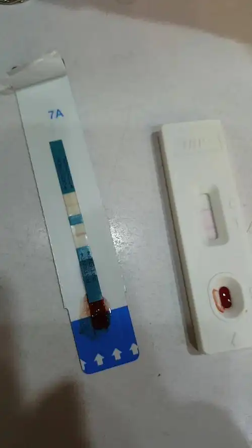 4年前长过尖锐湿疣,今天发现还染有艾滋病