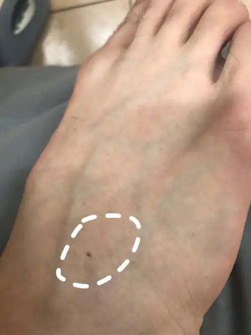 大夫不好意思又来问问题最近又忽然对身上的痣特别敏感了请