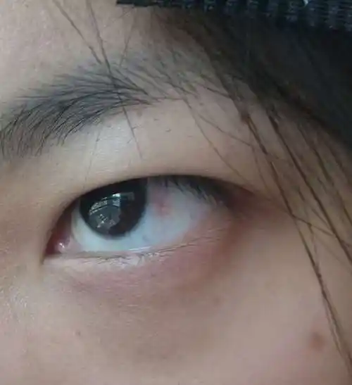 非常常见的 睑裂斑>