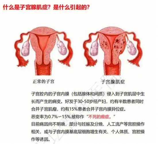 子宫腺肌症科普系列一