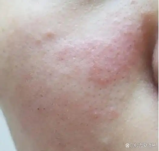 化妆要小心,假睫毛胶水也会引发脂溢性皮炎