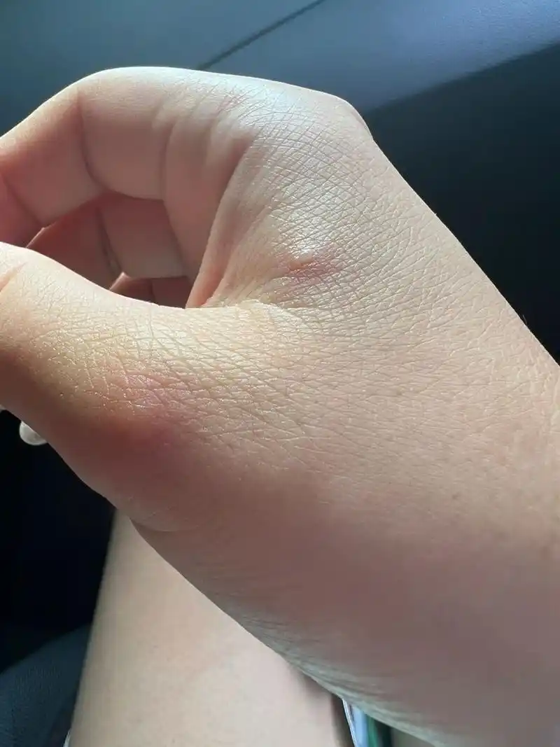 蚊子咬完起了小水泡吗?