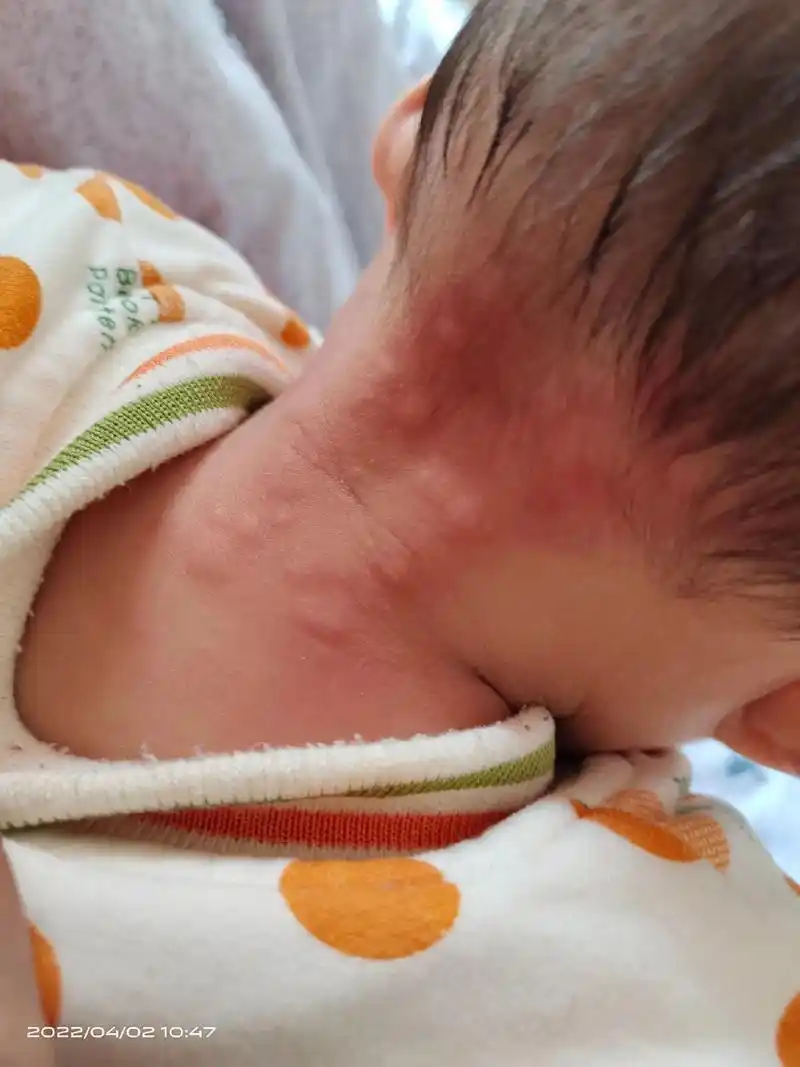 儿童荨麻疹 #过敏体质宝宝 #荨麻疹   - 抖音