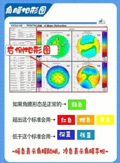 93角膜地形图:是通过角膜地形图仪检查近视人群的角膜形态.
