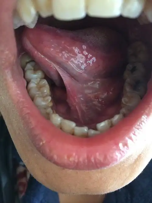 关于口腔尖锐湿疣的问题.麻烦专家帮忙看看.谢谢!