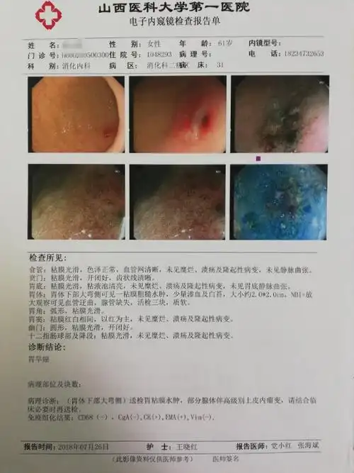 病例报告——山大一院胃镜室成功完成一例胃体下部早癌esd术