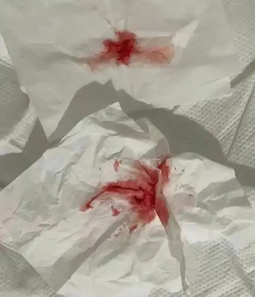 那晚,布布被上了呼吸机抢救,还咳出了鲜血.