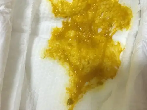 宝宝的便便像痰一样的黏液怎么回事,有懂的么.附图图